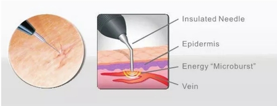 Salón de belleza Máquina láser de diodo 980nm para alivio del dolor / tratamiento vascular