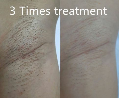 Dispositivo de depilación láser de diodos multifuncional que admite diferentes anchos de pulso para una reducción permanente del vello a medida