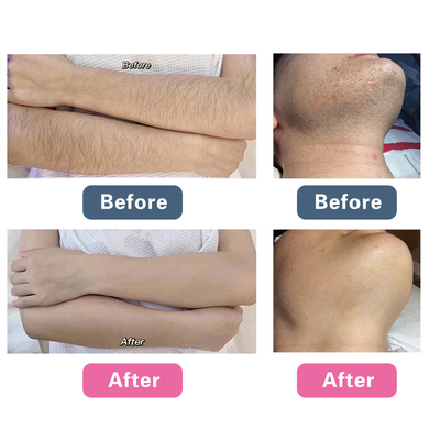 Máquina de rejuvenecimiento facial de láser de picosegundos, máquina de eliminación de tatuajes con Q.