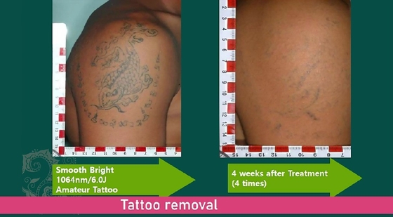 Máquina de rejuvenecimiento facial de láser de picosegundos, máquina de eliminación de tatuajes con Q.