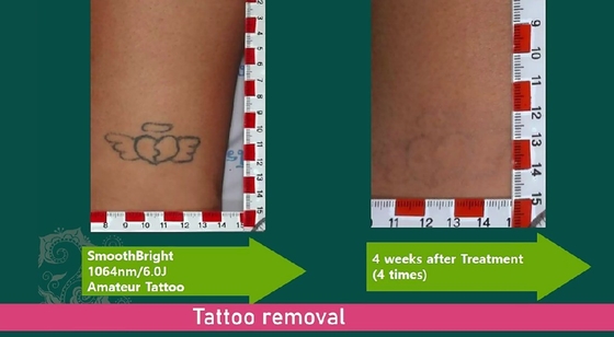 Máquina de eliminación de tatuajes con láser 1064nm 532nm 755nm