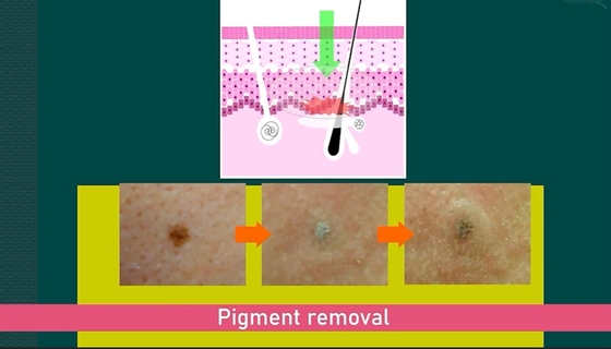 Máquina láser de picosegundos de 755nm para la depilación / eliminación de tatuajes Inglés Idiomas opcionales