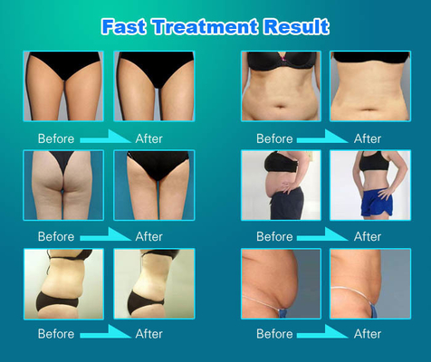 5 en 1 Máquina de adelgazamiento Vela, Máquina de reducción de celulitis Velashape para contorno de cara / cuerpo