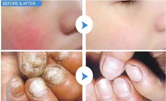 Máquina de extracción vascular con láser de 15W 30W para tratamiento de uñas / rejuvenecimiento de la piel con láser caliente