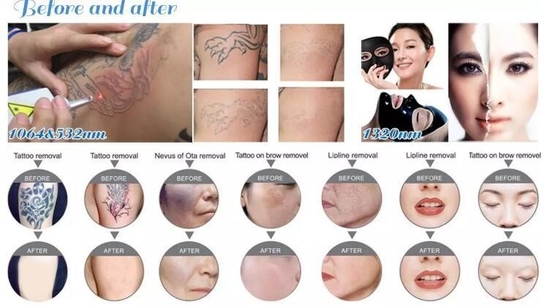 Máquina portátil de eliminación de tatuajes con láser Nd YAG 1064nm 532nm 1320nm