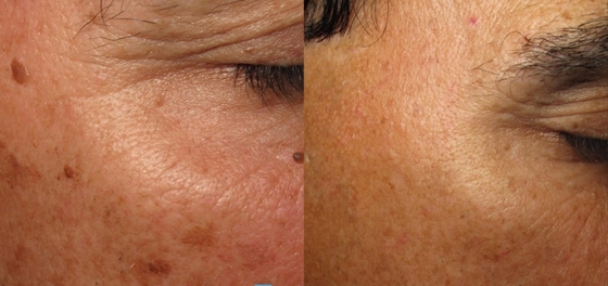 Inicio Nd YAG Máquina de belleza láser médica para pérdida de peso / ajuste de la piel