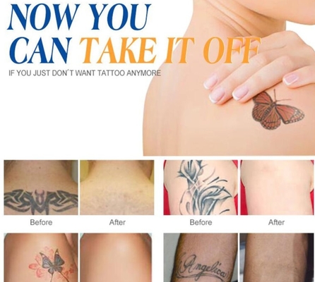 Máquina láser Q Switch ND Yag personalizada para la eliminación de tatuajes / tratamiento del acné
