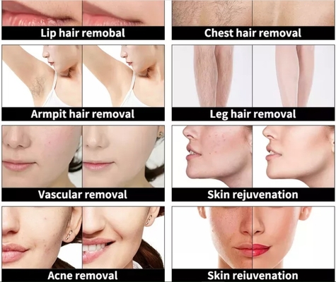 4 en 1 Máquina de belleza multifuncional de 3 longitudes de onda de láser