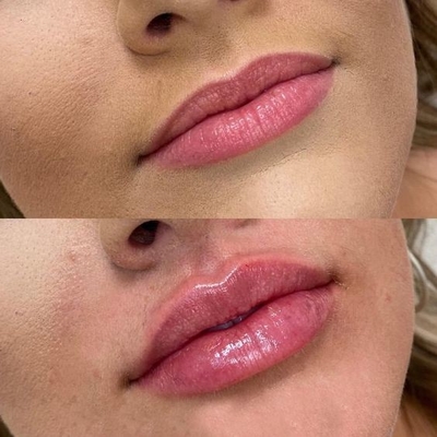 4 en 1 Máquina de belleza multifuncional de 3 longitudes de onda de láser